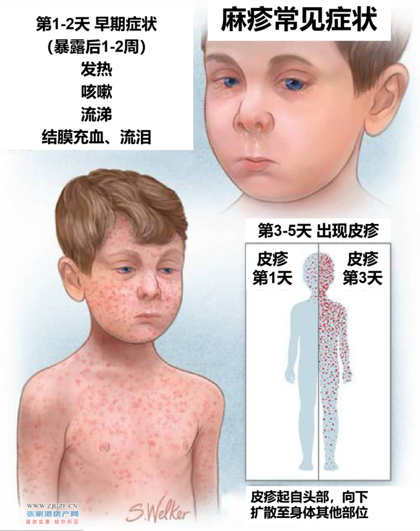 张家港疾控发布提醒免费麻腮风接种工作已经陆续开始初二在读的学生可